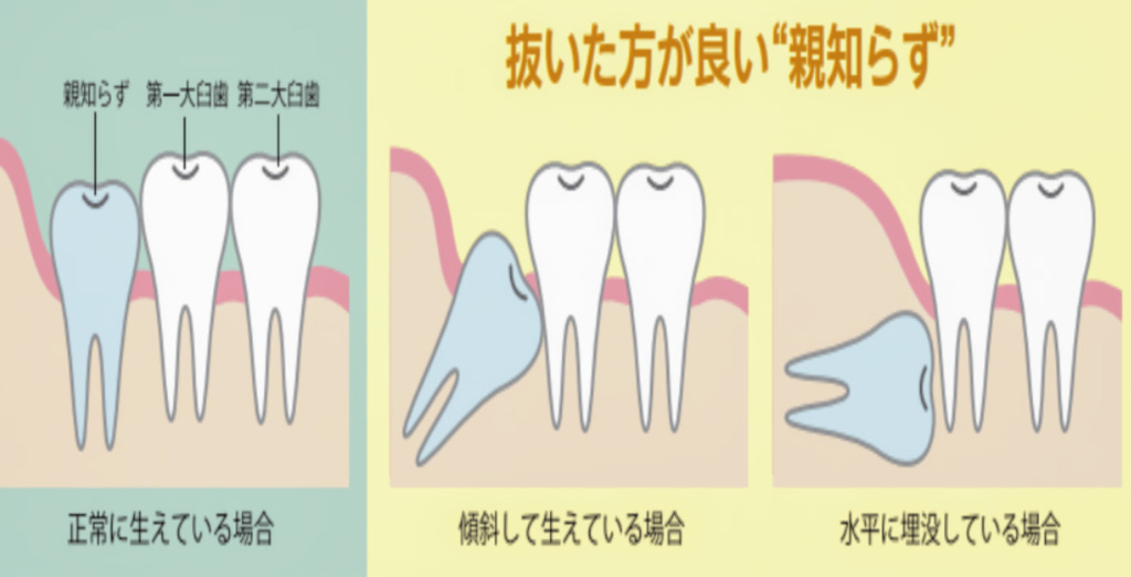 親知らずは抜いた方がいい？