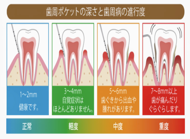 歯周病の有無が分かる歯周病ポケット測定検査