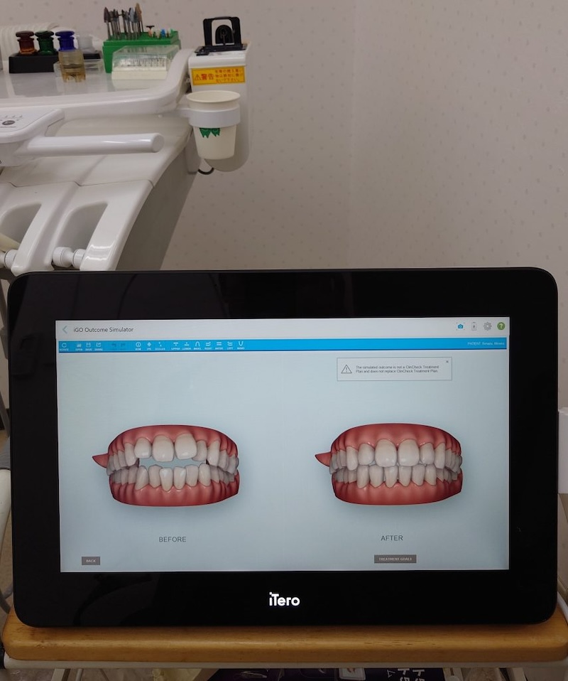 口腔内スキャナーiTero（アイテロ5D)の導入のお知らせ！